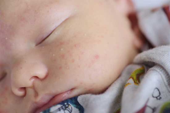 Acne neonatale